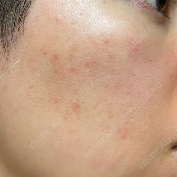 ルメッカ ルラ美容クリニック 大宮院 / ルラスキンクリニック 大宮院 DAY 2 メイン用