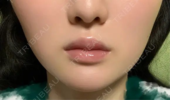 ボトックス（エラ・小顔） / ヒアルロン酸注入（唇） / ボトックス（口角） / ボトックス（人中） L‘amour clinic Tokyo【ラムールクリニック東京】 DAY 7 メイン用