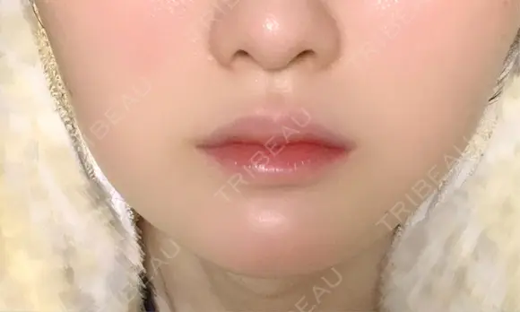 ボトックス（エラ・小顔） / ヒアルロン酸注入（唇） / ボトックス（口角） / ボトックス（人中） L‘amour clinic Tokyo【ラムールクリニック東京】 DAY 15 メイン用