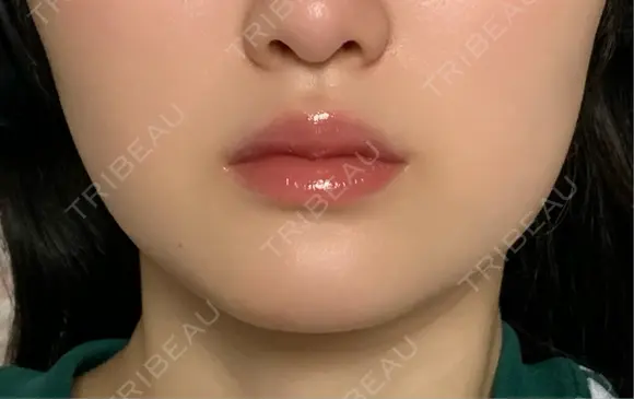 ボトックス（エラ・小顔） / ヒアルロン酸注入（唇） / ボトックス（口角） / ボトックス（人中） L‘amour clinic Tokyo【ラムールクリニック東京】 DAY 16 メイン用
