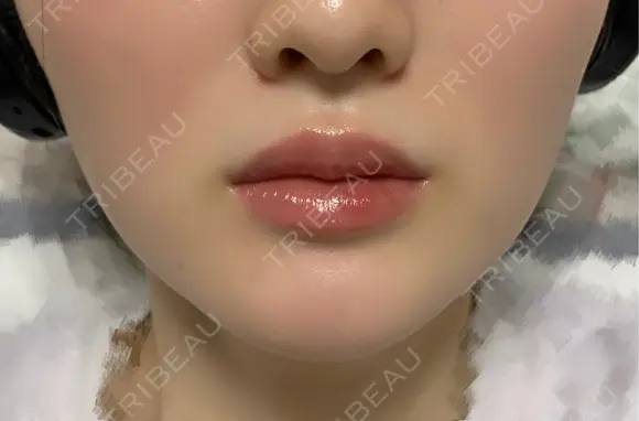 ボトックス（エラ・小顔） / ヒアルロン酸注入（唇） / ボトックス（口角） / ボトックス（人中） L‘amour clinic Tokyo【ラムールクリニック東京】 DAY 42 メイン用