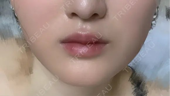 ボトックス（エラ・小顔） / ヒアルロン酸注入（唇） / ボトックス（口角） / ボトックス（人中） L‘amour clinic Tokyo【ラムールクリニック東京】 DAY 79 メイン用