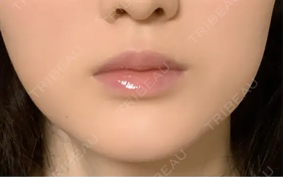 ボトックス（エラ・小顔） / ヒアルロン酸注入（唇） / ボトックス（口角） / ボトックス（人中） L‘amour clinic Tokyo【ラムールクリニック東京】 DAY 142 メイン用