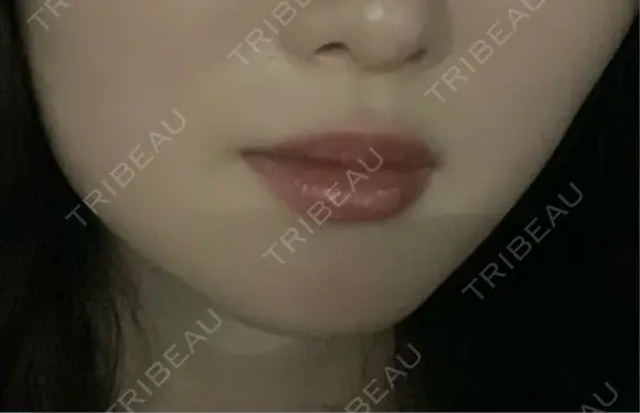 ボトックス（エラ・小顔） / ヒアルロン酸注入（唇） / ボトックス（口角） / ボトックス（人中） L‘amour clinic Tokyo【ラムールクリニック東京】 AFTER メイン用