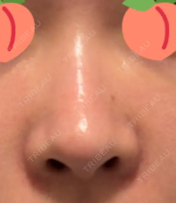 鼻尖形成（切開） / 骨削り（頬） / 軟骨移植 / 鼻孔縁挙上 THE ROPPONGI CLINIC（ザ 六本木クリニック） DAY 275 メイン用