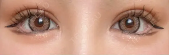 二重切開 / 眼瞼下垂（切開） ユア美容クリニック 福岡院 DAY 13 メイン用