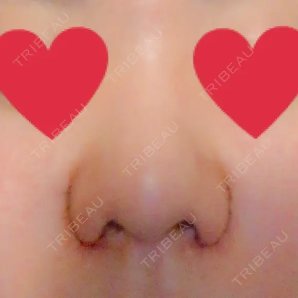 小鼻縮小（切開） ヴェリィ美容形成クリニック DAY 3 メイン用