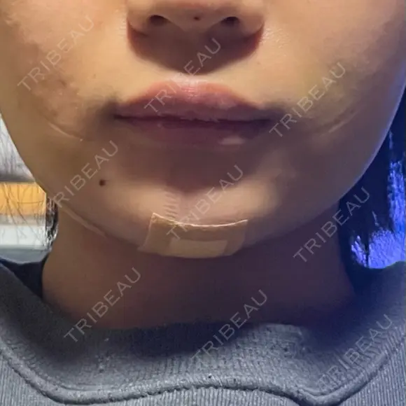 二重埋没 / 糸リフト / 脂肪吸引注射（顔） / ヒアルロン酸注入（涙袋） / 肌ヒアルロン酸注入（たるみ・シワ改善） / ヒアルロン酸注入（あご） / ボトックス（エラ・小顔） / ヒアルロン酸注入（唇） / ボトックス（口角） / シワ取りボトックス / その他（鼻） / その他（口元） TCB東京中央美容外科 熊本院 AFTER メイン用