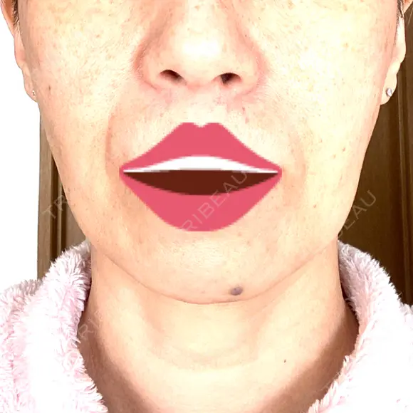 ボトックス（エラ・小顔） / ヒアルロン酸注入（頬） 新未来クリニック DAY 1 メイン用