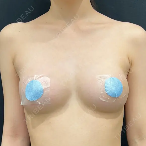 クマ治療 / 豊胸（脂肪注入） / 脂肪注入（額） / 脂肪注入（目の下） / 脂肪注入（輪郭） 湘南美容クリニック 吉祥寺院 AFTER メイン用