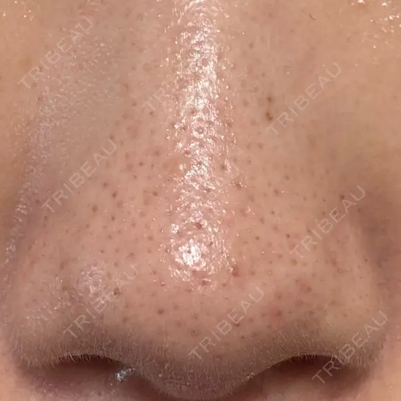 アグネス 日本美容・医療クリニック 六本木院 DAY 14 メイン用