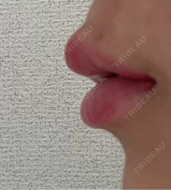 人中短縮 / ヒアルロン酸注入（唇） / ボトックス（口角） ルラ美容クリニック 名古屋栄院 / ルラスキンクリニック 名古屋栄院 DAY 2 メイン用