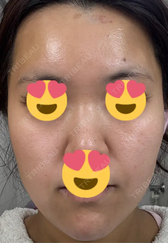 医療脱毛（顔） 日本美容・医療クリニック 六本木院 DAY 5 メイン用