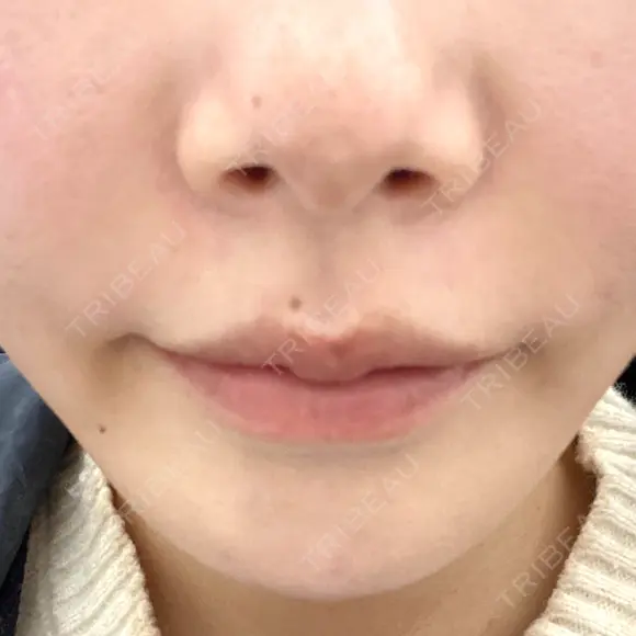 ボトックス（口角） / ボトックス（額） / ハイフ（顔） TCB東京中央美容外科 広島院 DAY 0 メイン用