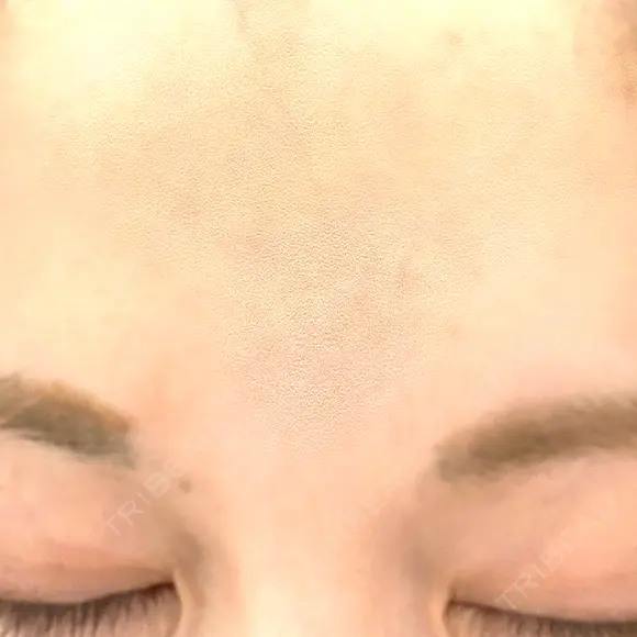 ボトックス（口角） / ボトックス（額） / ハイフ（顔） TCB東京中央美容外科 広島院 DAY 0 メイン用