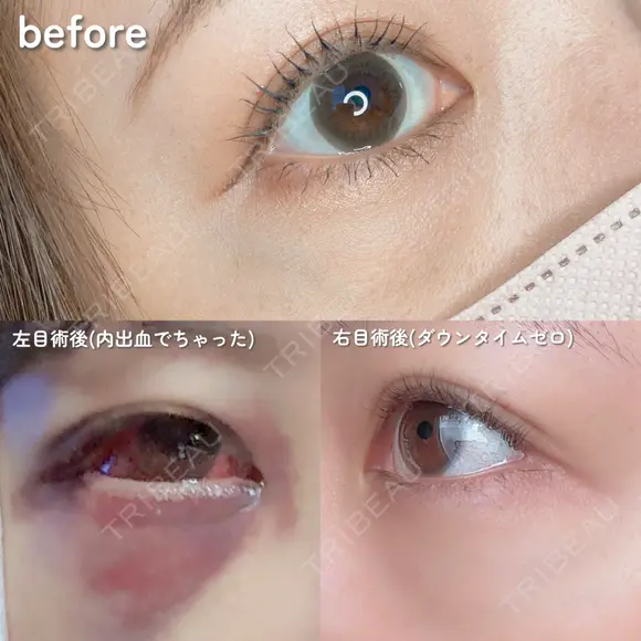 クマ治療 PRISM Beauty Clinic 町田院 DAY 0 メイン用