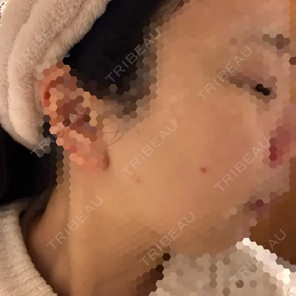 ほくろ・いぼ切除（肌） KARIS beauty clinic DAY 29 メイン用