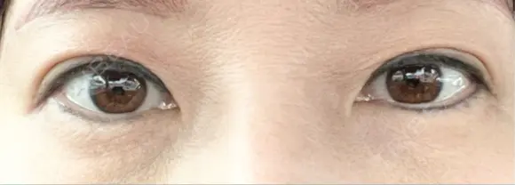 二重埋没 / ヒアルロン酸注入（目の下） アーティスクリニック 博多 DAY 5 メイン用