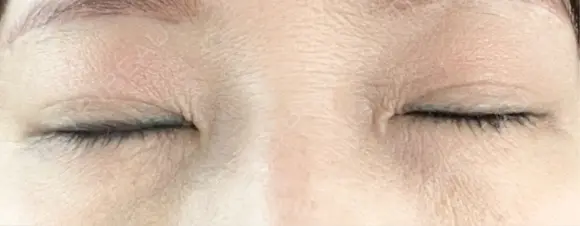 二重埋没 / ヒアルロン酸注入（目の下） アーティスクリニック 博多 DAY 5 メイン用