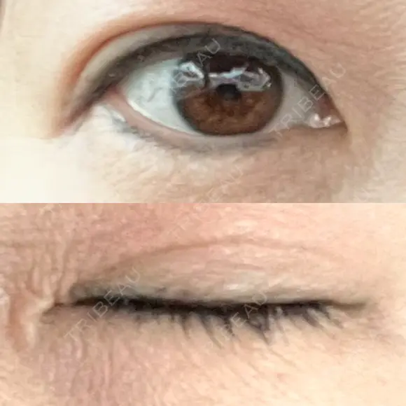 二重埋没 / ヒアルロン酸注入（目の下） アーティスクリニック 博多 DAY 5 メイン用