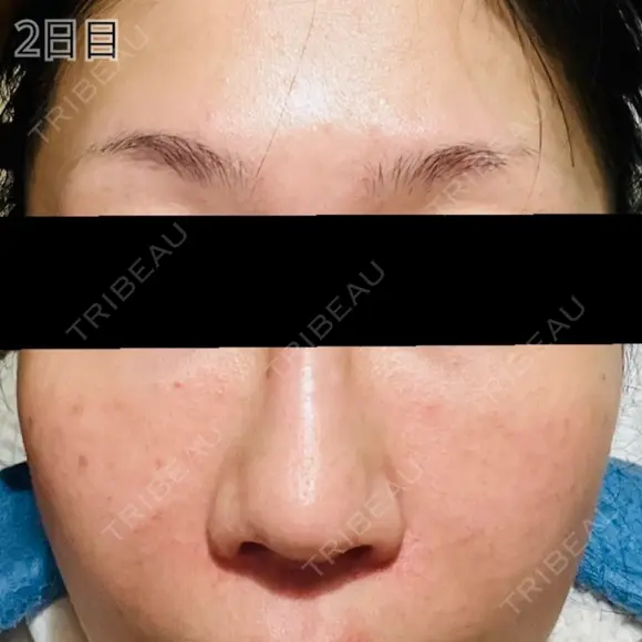 肌育注射（ジュベルックなど） / リジュラン 新宿Ladies&Gentlemen美容クリニック DAY 2 メイン用