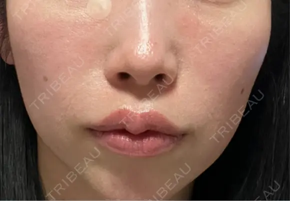 ヒアルロン酸注入（頬） 湘南美容クリニック 大阪梅田本院 AFTER メイン用