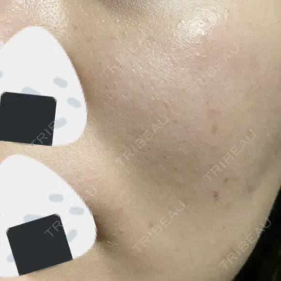 ルメッカ Belle Via Skin Clinic DAY 9 メイン用