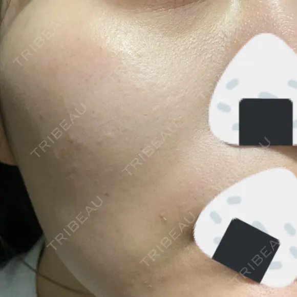 ルメッカ Belle Via Skin Clinic DAY 9 メイン用