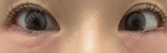 光治療（フォトフェイシャルなど） / その他（目元） スマートスキンクリニック 神保町院 DAY 0 メイン用