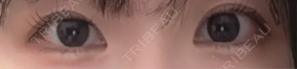 光治療（フォトフェイシャルなど） / その他（目元） スマートスキンクリニック 神保町院 AFTER メイン用