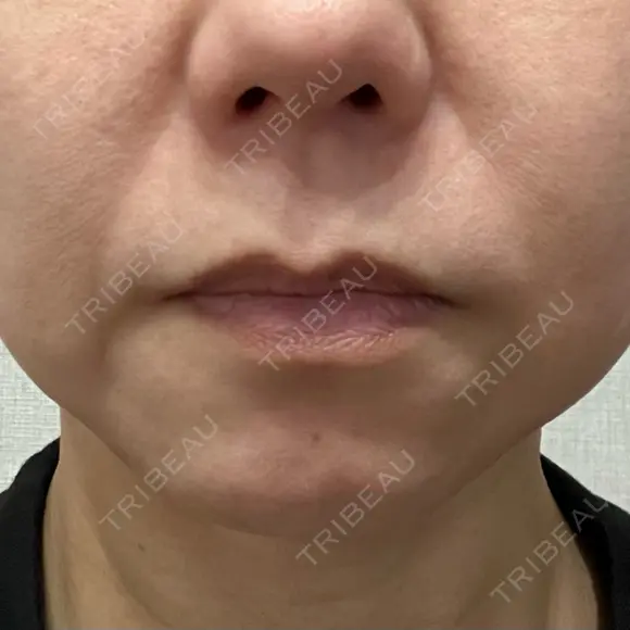 RF（高周波）たるみ治療 大美会クリニック 心斎橋本院 AFTER メイン用