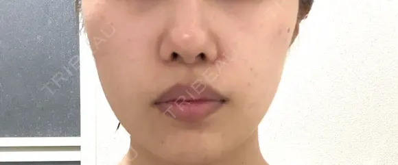 ボトックス（エラ・小顔） / ボトックス（肩） / ワキ汗治療（ボトックス） おおたかの森ビューティークリニック DAY 8 メイン用