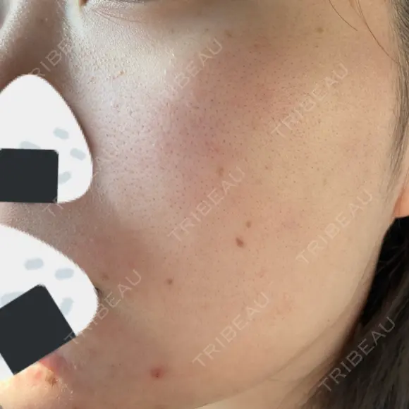 ルメッカ Belle Via Skin Clinic DAY 10 メイン用