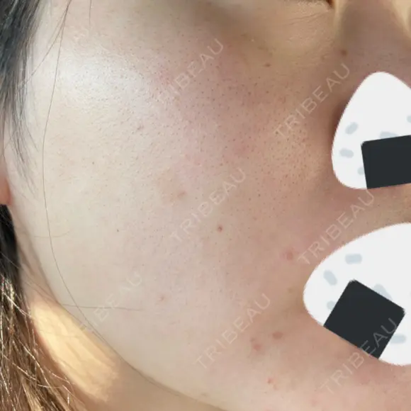 ルメッカ Belle Via Skin Clinic DAY 10 メイン用