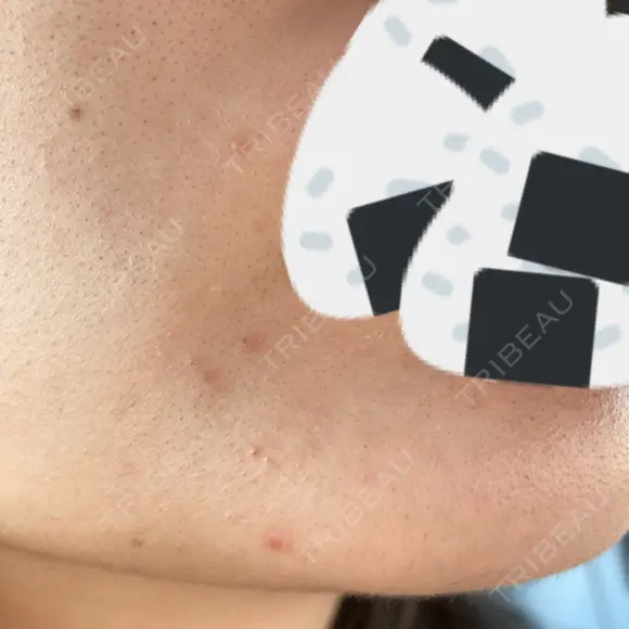 ルメッカ Belle Via Skin Clinic DAY 10 メイン用