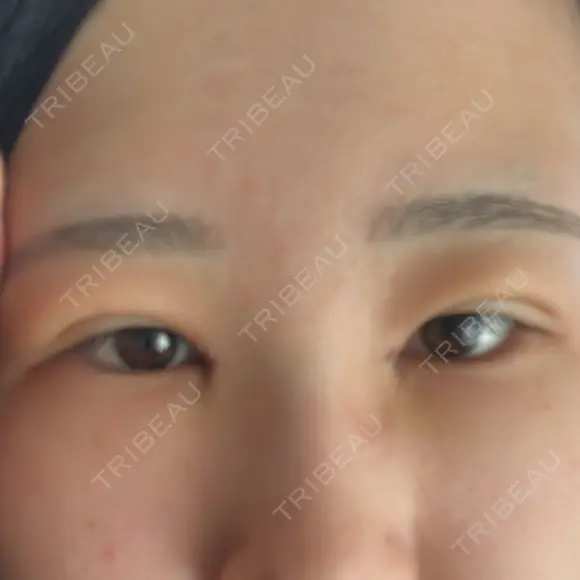 二重埋没 / 目頭切開 / 上まぶたの脂肪取り HAAB×DREAM BEAUTY CLINIC 東京本院 AFTER メイン用