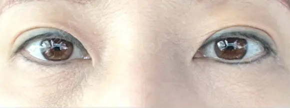 二重埋没 / ヒアルロン酸注入（目の下） アーティスクリニック 博多 DAY 7 メイン用