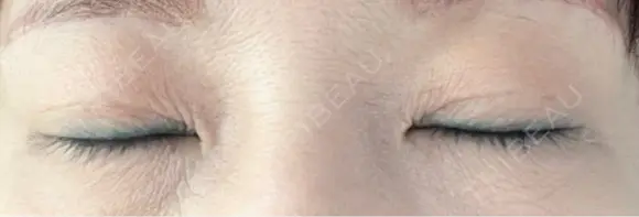 二重埋没 / ヒアルロン酸注入（目の下） アーティスクリニック 博多 DAY 7 メイン用