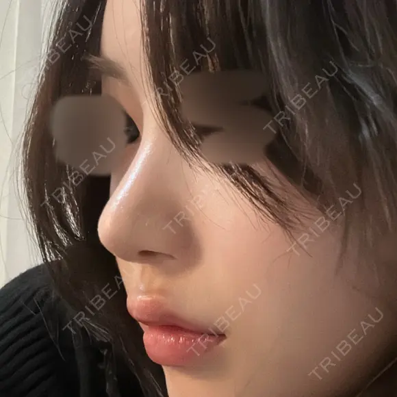鼻尖形成（切開） / 軟骨移植 / 骨切幅寄せ / ワシ鼻修正・ハンプ切除 WOM CLINIC GINZA （ワム クリニック ギンザ） AFTER メイン用