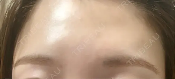 ボトックス（口角） / ボトックス（額） / ハイフ（顔） TCB東京中央美容外科 広島院 AFTER メイン用