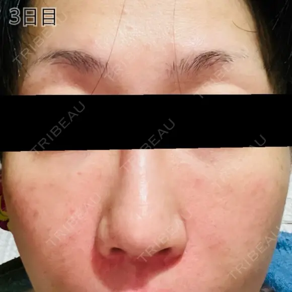 肌育注射（ジュベルックなど） / リジュラン 新宿Ladies&Gentlemen美容クリニック DAY 3 メイン用