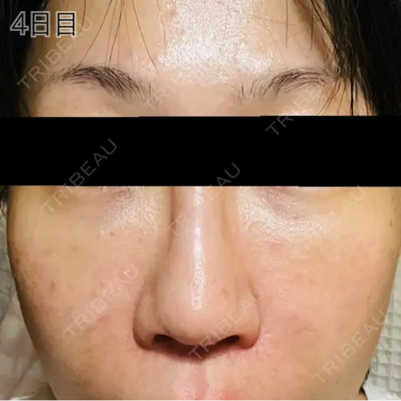 肌育注射（ジュベルックなど） / リジュラン 新宿Ladies&Gentlemen美容クリニック DAY 4 メイン用