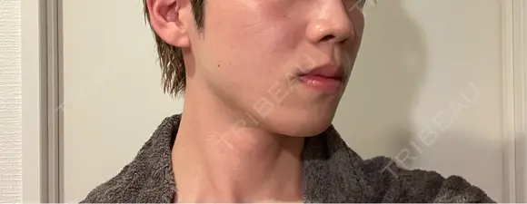 ボトックス（エラ・小顔） / ヒアルロン酸注入（鼻翼基部） KAGA CLINIC AFTER メイン用