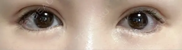 二重切開 / 眼瞼下垂（切開） ユア美容クリニック 福岡院 DAY 18 メイン用