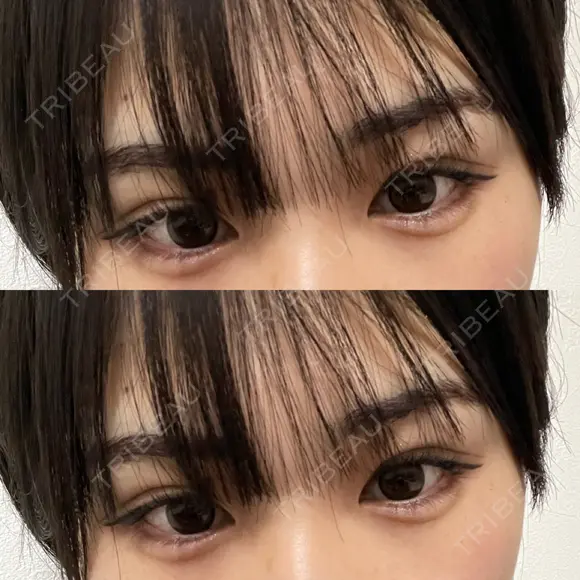 ヒアルロン酸注入（涙袋） AYANAフィラーズクリニック 渋谷院 AFTER メイン用