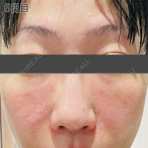 肌育注射（ジュベルックなど） / リジュラン 新宿Ladies&Gentlemen美容クリニック DAY 6 メイン用