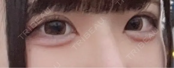 ヒアルロン酸注入（涙袋） Olino美容外科・美容皮膚科 DAY 9 メイン用