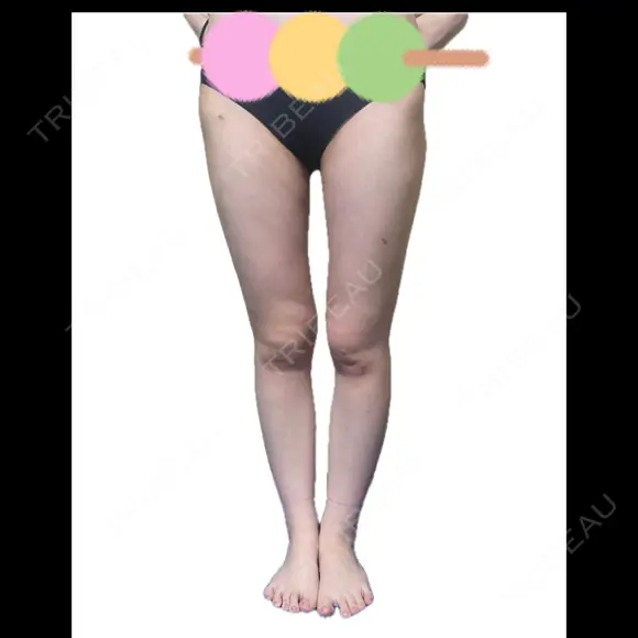 脂肪吸引（二の腕） / 脂肪吸引（脚） / 豊胸（脂肪注入） BBC銀座院 AFTER メイン用