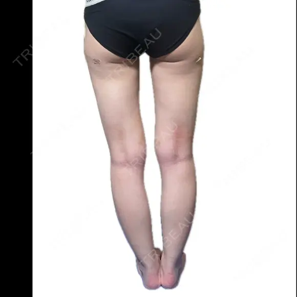 脂肪吸引（二の腕） / 脂肪吸引（脚） / 豊胸（脂肪注入） BBC銀座院 DAY 14 メイン用