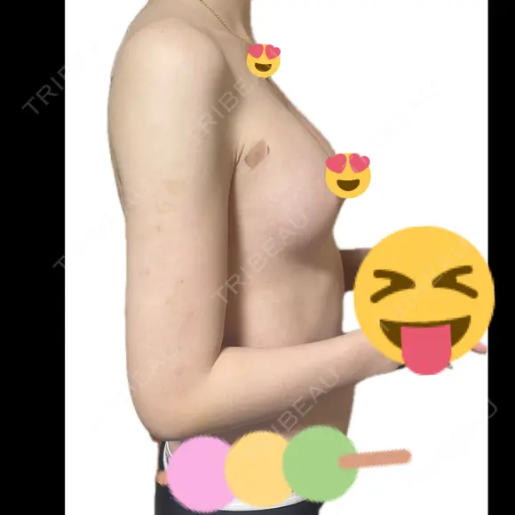 脂肪吸引（二の腕） / 脂肪吸引（脚） / 豊胸（脂肪注入） BBC銀座院 DAY 14 メイン用